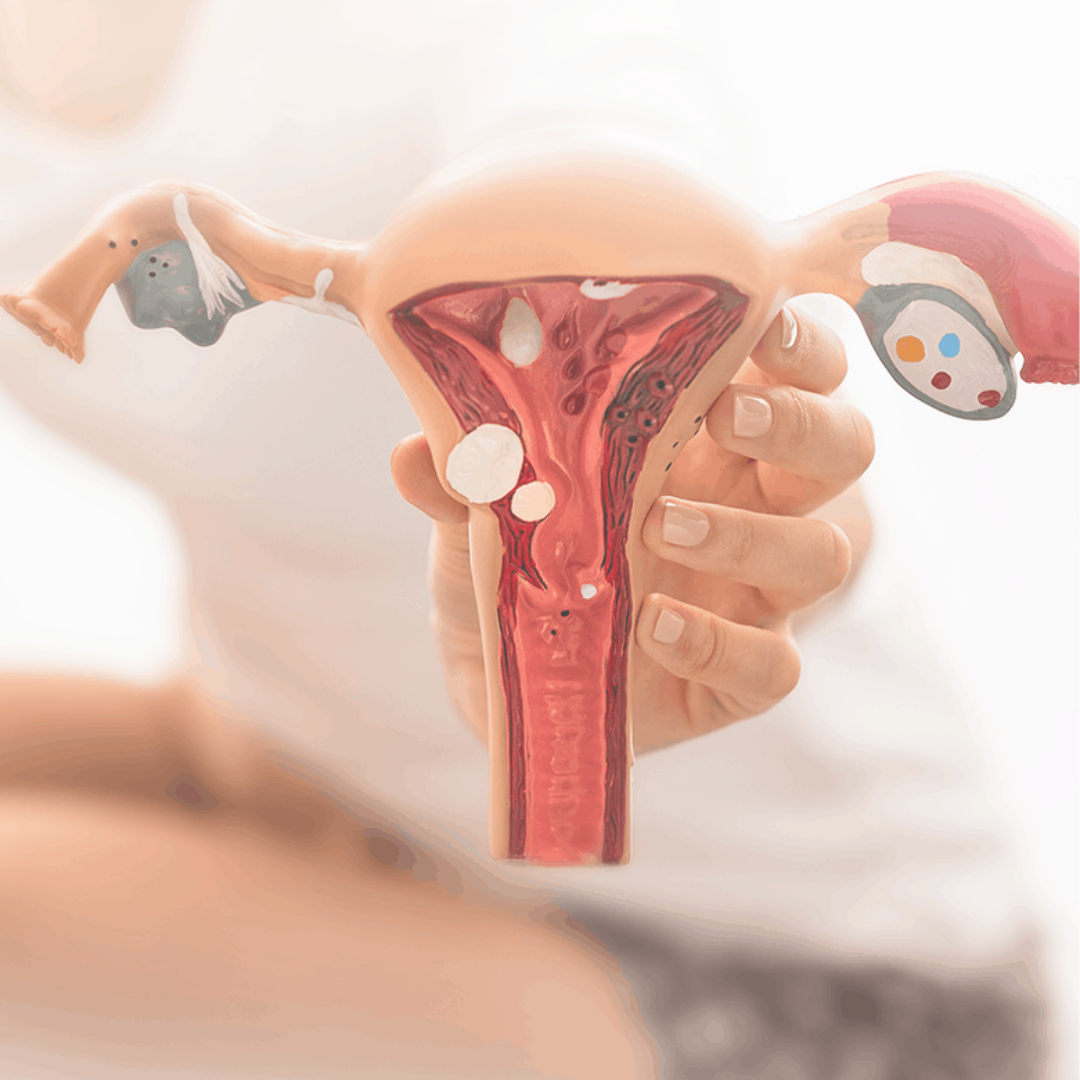 Endometriose afeta a fertilidade, saiba o que fazer